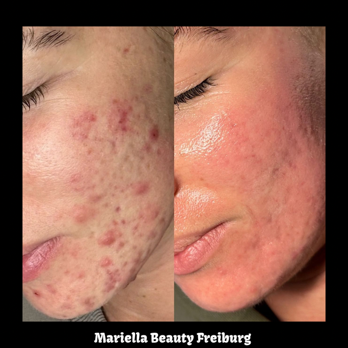 Microneedling